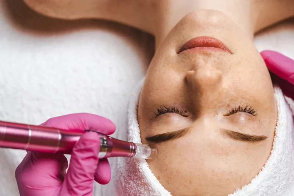 Microneedling Benefits