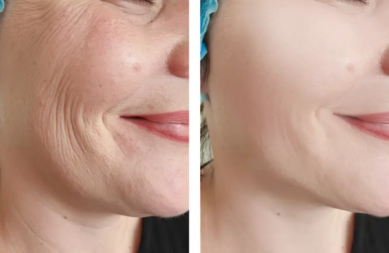neurotoxins for wrinkles